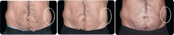 Fotostrecke - Coolsculpting